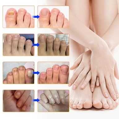 Toenail Fungus Treatment Extra Strength - 32 Pcs Fungal Nail Patches, Nail Repair for Damaged Nails, Overnight Renewal for Men and Women - Image 5