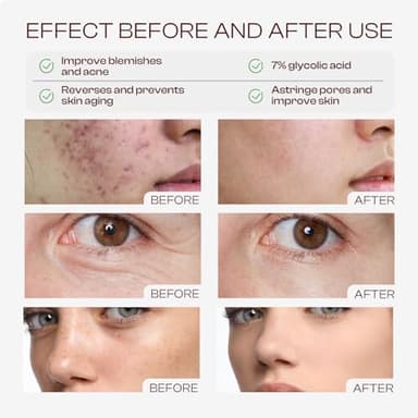 Glycolic Acid Toner: 240ml Glycolic Acid 7% Exfoliating Toner Toning Solution Which Soothes and Hydrates Skin - Image 3