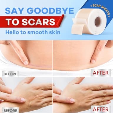 Wifamy Silicone Scar Sheets for Women: Medical Grade Scar Removal C-Section Recovery & Post-Surgery Care (1.6"X 60" Roll-1.5M) - Image 3