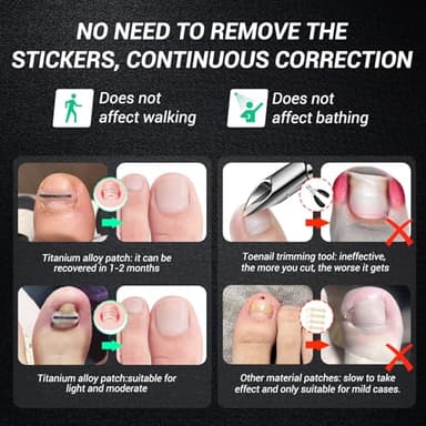 Reieset Titanium Alloy Ingrown Toenail Treatment, Nail Tools, and Ingrown Toenail Removal Kit Specially Designed for Curved Nail Repair and Ingrown Toenail Corrector (0.59/0.67in) - Image 5