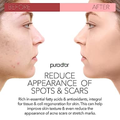 PURA D'OR 4 Oz ORGANIC Rosehip Seed Oil - 100% Pure Cold Pressed USDA Certified Anti-Aging Treatment - Vitamin A & C Rich - Helps Fade Appearance of Scars & Stretch Marks - For Face, Hair & Body - Image 6