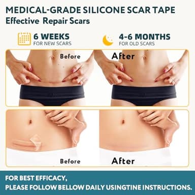 Silicone Scar Sheets, Silicone Scar Tape for Surgical Scars - 60" x 1.6" Roll - 1.5M, Medical Grade Reusable Effective Scar Removal for Keloid, C-Section, Tummy Tuck, and Acne - Image 3