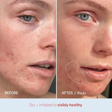 First Aid Beauty - Ultra Repair Cream, Intense Hydration Whipped Colloidal Oatmeal, Clinically Proven to Strengthen Skin Barrier in 7 Days & Helps Relieve Eczema, Luxury Moisturizer, 6 oz + Bonus, 2ct - Image 5