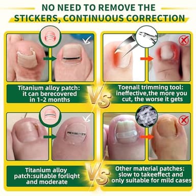 Large Size-Titanium Alloy Ingrown Toenail Treatment & Removal Kit for Quick Relief, Ingrown Toenail Removal Kit, Professional Ingrown Toenail Corrector, Ingrown Toenail Tools for Quick Relief, 10 Pcs - Image 4